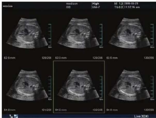 MEDICUM medison OB High V44-7 MI 1.3 (2006-05-29) Tb 0.2 (1:12:16 am) 62.5 mm 128/256 63.0 mm 129/256 63.5 mm 130/255 64.0 mm 131/256 64.5 mm 132/256 64.9 mm 133/256 Live 3DXI