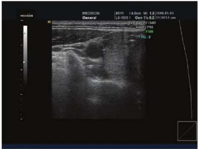 MEDISON General M #511 (4.0cm MI 1.3)2085-05-03 L8-1915 / Gen Tls 0.2 17:34:51 am 120 0.27/11:00 1216/190 F300 Tg : 0