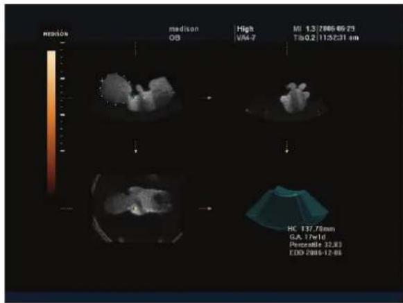 mation medison OB High V4-7 MI 1.3/2005-05-23 Tis0.2/115Z31 am HC 137.76mm GA 17w16 Perceable 32.83 EDD 2005-12-06