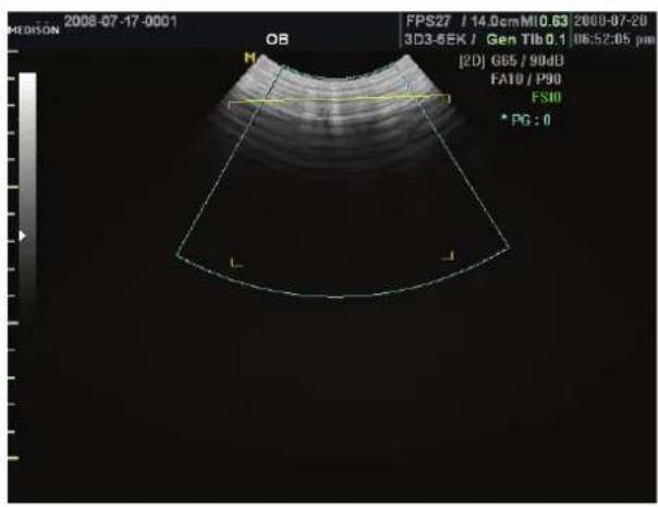 2008-07-17-0001 MEDISON OB M FPS27 / 14.0cmM10.63 | 2000-07-20 3D3-5EK / Gen Tlb 0.1 | 06:52:05 pm [20] G65 / 90dB FA10 / P90 FS10 * PG : 0