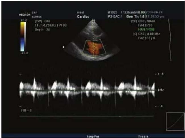 M0103 car stress 70.0 (CM) GOS F1 /14.29 kHz /P100 Depth 78 med Cardiac #1023 / 12.0cm/MID 09/2006-16-28 P3-SAC / Gen Tls 1& 12:06:53 pm [20] GSO / 9048 FA4 /P30 HA1 /FSB [C] GSO / 4.80 kHz FA2 /F2 /B HR = II Loop Pos Freeze