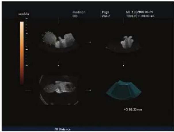 medison medison OB High VA4-7 MI 1.2 2006-06-29 T1b0.2 11:49:43 am +0 $8.30mm 70 Distance