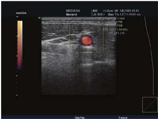 MEDISON General #60 /4.0cm MI 1.0/2006 05:03 LB-1SIS / Gen TIs 1,1/13:30:02 am 20/05/11:00 F510/790 FS8 P90 GSB/1.58 kHz F6/1/1/15 One Pos Freeze