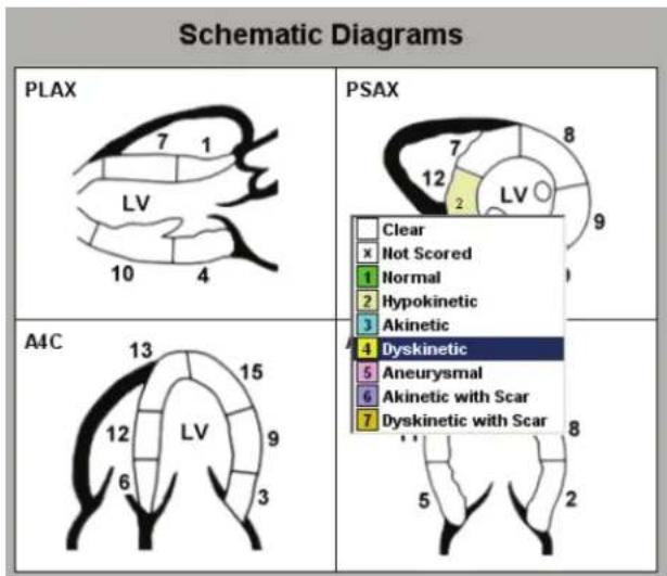 Schematic Diagrams PLAX 7 1 LV 10 4 PSAX Clear x Not Scored Normal 2 Hypokinetic 3 Akinetic 4 Dyskinetic 5 Aneurysmal 6 Akinetic with Scar 7 Dyskinetic with Scar A4C 13 15 12 LV 6 3 5 8