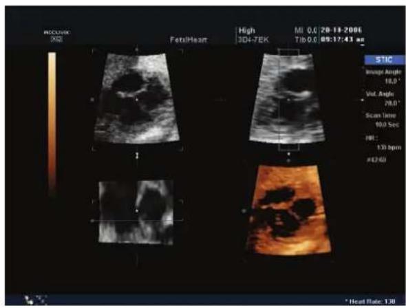 PROCURV 2021 FetalHeart High MI 0.6 28-18-2006 304-7EK Tib 0.6 09:17:41 am STIC Image Angle 18.0° Vol. Angle 20.0° Scan Time 10.0 sec HR 130 bpm #E7/61 *Head Rate: 130