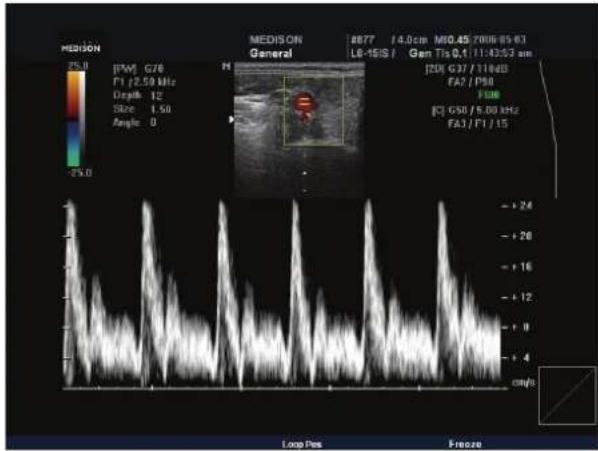 MEDISON 25.0 [FW] G76 F1 / 2.59 MHz Depth 12 Size 1.50 Angle 0 MEDISON General 4877 / 4.0cm M10.45 7006-85-63 L6-16S / Gen Tis 0,1 11:43:53 am [20] G37 / T18dB FA2 / P90 FAB [Q] G50 / 5.00 Hz FA3 / F1 / 15 - + 24 - + 26 - + 16 - + 12 - + 8 - + 4 cm/s Loop Pos Freeze
