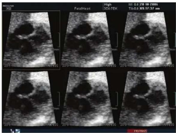 RECOVIX 3021 FetalHeart High 3D8.7EK MI 0.0/20 10 2005 Tib 0.0 01:17:37 am 2014 mm 1935.15 2013 mm 1946.15 2014 mm 1935.15 2013 mm 1946.15 2014 mm 1935.15 1937/07/23