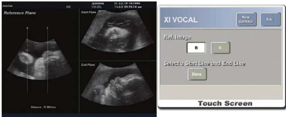 Reference Plane S E Distance : 37.865mm Start Plane End Plane XI VOCAL New Contour Exit: Ref. Image B C Select a Start Line and End Line Done Touch Screen