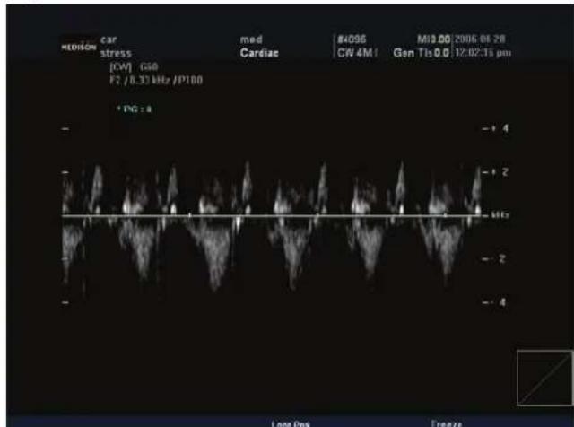 MEDISON car stress GW G60 F2 / 0.33 MHz / P100 * PG ≥ 8 med Cardiac #4096 CW 4M1 M19.00 2006-06-28 Gen Tls 0.0 12:02:15 pm - + 4 - + 2 - + 1 - - 2 - - 4 Log Px Freeze