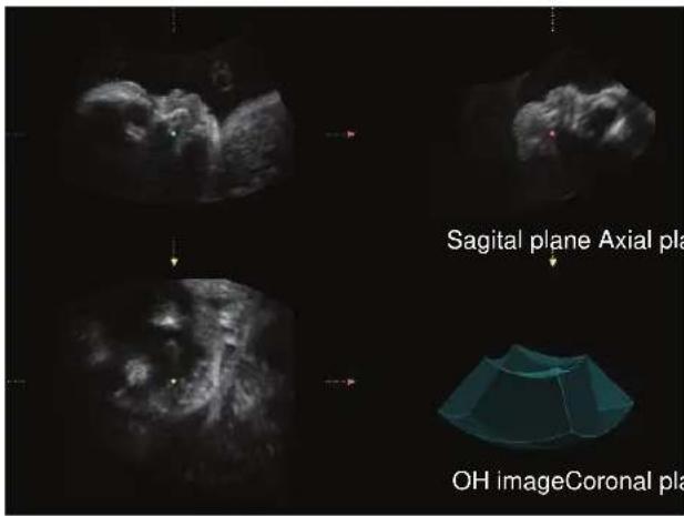 Sagital plane Axial pla OH imageCoronal pla