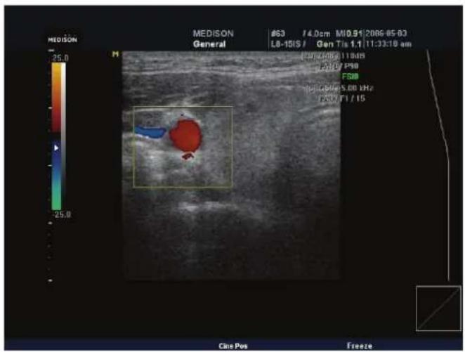 MEDISON General #63 /4.0cm M10.91 2066-05-03 LB-1015 / Gen Tis 1.1/11:33:10 am EPR 0.08/11:04B M10 P50 FSIB HR LBP 5.00 kHz CSX F1 / 15 Cine Pos Freeze