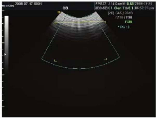 MEDISON 2008-07-17-0001 OB FPS27 / 14.0emMI0.63 2008-07-20 3D3-5EK / Gen Tib0.1 06:52:05 pm [2D] G65 / 90dB FA10 / P90 FS10 * PG : 0