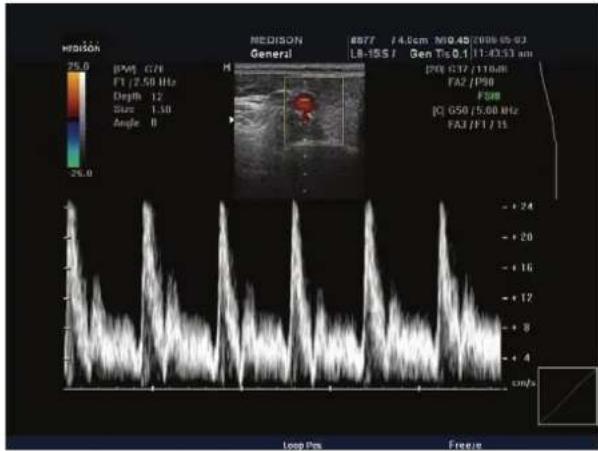 MEDISON General 6877 /4.5cm N10/49/2006-05-93 LB-15S / Gen Tg 0.1/11:43:31 am (200 G17/110dB) FA2/P90 F38R (0) G50/5.00 Hz FA3/F1/15 25.0 25.0 Loop Pcs Freeze