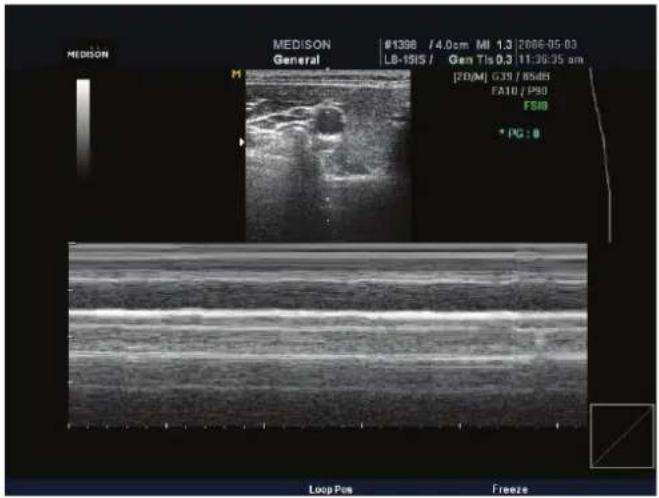 MEDISON General M1 MEDISON #1398 / 4.0cm MI 1.3 2006-05-03 LB-1915 / Gan Tls 0,3 11:30:35 am [20/M] G39 / 85dB FA10 / P30 FSBD * PC : 0 Loop Pos Freeze