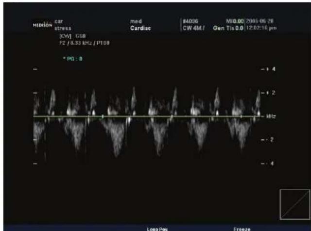MEDISON CAR stress [CW] GGB F2 /8.33 kHz / P100 * PG : 0 MEDISON CAR stress med Cardize #4096 MID.00 2005-06-28 CW 4M/ Gen Tis 0.0 12:02:16 pm - + 4 - + 2 - - 1 - - 2 - - 4 Loop Pos Freeze