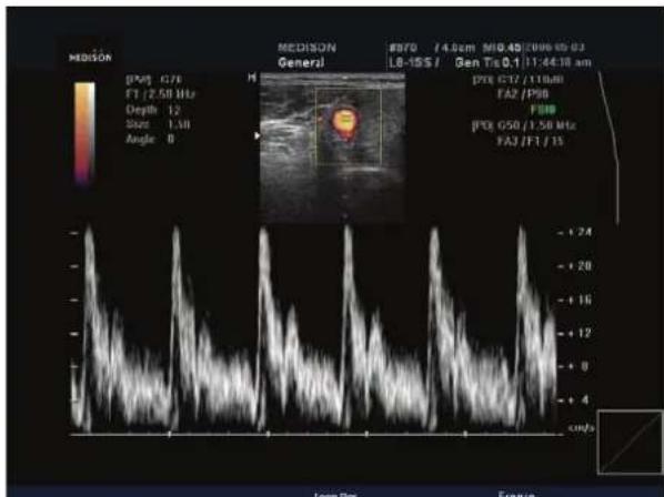 MEDISON DPM: G76 F1 / 2.50 MHz Depth: 1.2 Size: 1.58 Angle: 0 MEDISON General R970 / 4.8cm M10.45/2006-03 L8-15S / Gen Tg 0.1/11:44:38 am DPM: G17/11:00 FA2 /P98 F99 P98: G50 / 1.58 MHz FA3 /F1 / 15 + 24 + 20 + 16 + 12 + 8 + 4 c/mPa Loop Pos Freeze