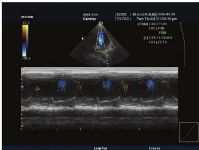 MEDISON Cardiac #2055 / 16.0cm M10.62/ 2086-05-28 P3-7AC / Pen Tis 0.6 / E3SE:30 pm [20MJ G60 / 35sD] FA2 / P90 FSB [C] G70 / 4.50 kHz FA4 / F2 / 0 Loop Pos Freeze