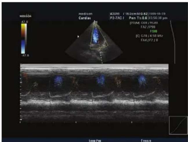 MEDISON Cardias #2050 / 16.0cmM10.82/2008-06-20 P3-7AC I Pen Tis 0.6 03:56:10 pm [2004] G30/95aB FA2 /P90 FSB [Q] G70/4.58 MHz FA4 /F2 / B Loop Pan Freeze