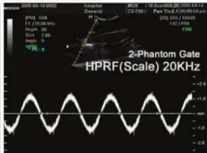 2008-04-14:00:02 HPV: Gain E7 (25.0 MHz) Depth: 30 Size: 2.66 Angle: 9 % : 0 Hospital General AE28 / 15 GmMAD 28/15/04 04:18 CS-TSM / Pen Tio 0.1 / 95/95/14 μm (50) 0.05 / 110dB 1.82 / 159 HPRF(Scale) 20KHz
