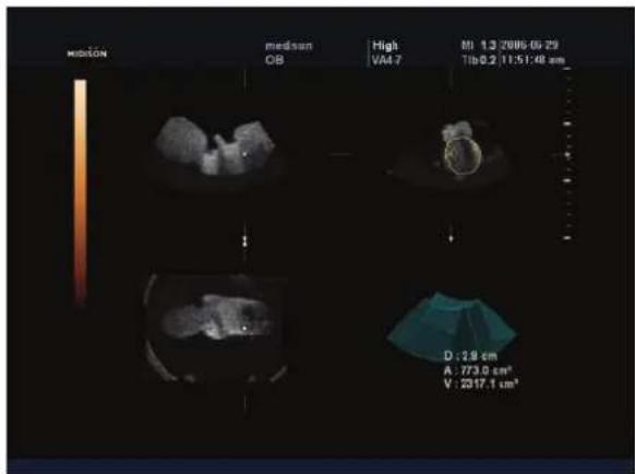 medizin medizin OB High VA4.7 MI 1.3 2006-05-29 Tib 0.2 11:51:48 am D:2.9 cm A: 773.0 cm² V: 2017.1 cm²