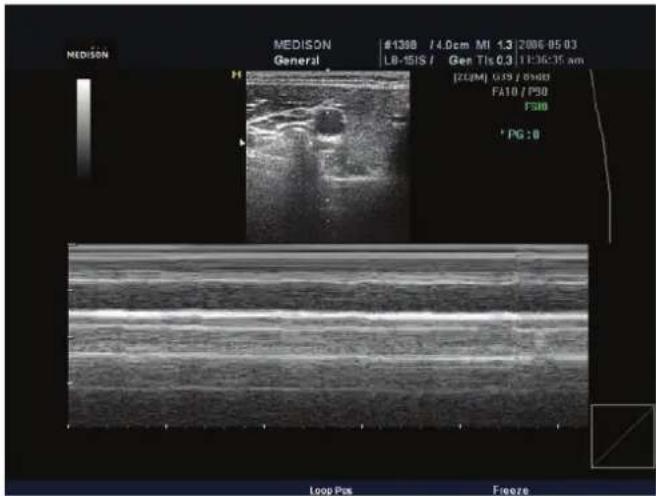 MEDISON General M1300 / 4.0cm MI 1.3/2006-05-03 L0-1SIS / Gen TIs 0.3 / TC6:35 nm [2006] GSS / 8988 FA10 / P90 FSIB PG:0 Loop Pos Freeze