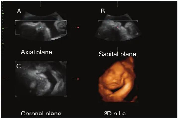 A Axial plane B Sagittal plane C Coronal plane 3D n La