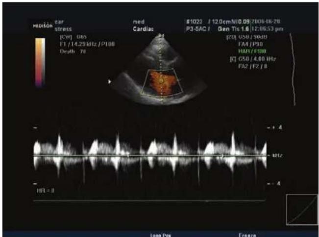 MOHOS car stress med Cardiac #1020 / 12.0cm NID 08/2006-06-28 P3-SAC / Gen Tis 1.6 / 12:06:53 pm [CV] GSB F1 / 14.29 kHz / P100 Depth 78 [CQ] GSB / 90dB FAM / P30 HAN / FSB [C] GSO / 4.80 Hz FA2 / F2 / B HR = 3 Loop Nex Freeze