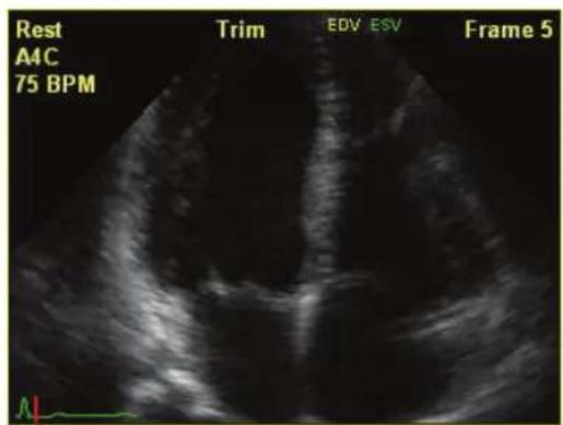 Rest A1C 75 BPM Trim EDV ESV Frame 5