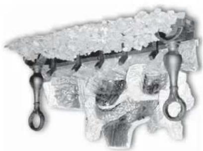 Close-up of a dental implant with metal handles and decorative base (no text or symbols visible)