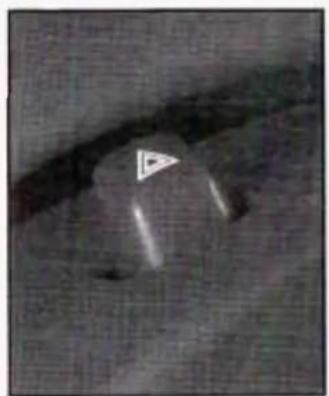Grayscale medical scan image showing a dark anatomical structure with a white arrow pointing to a specific region (no text or symbols visible)