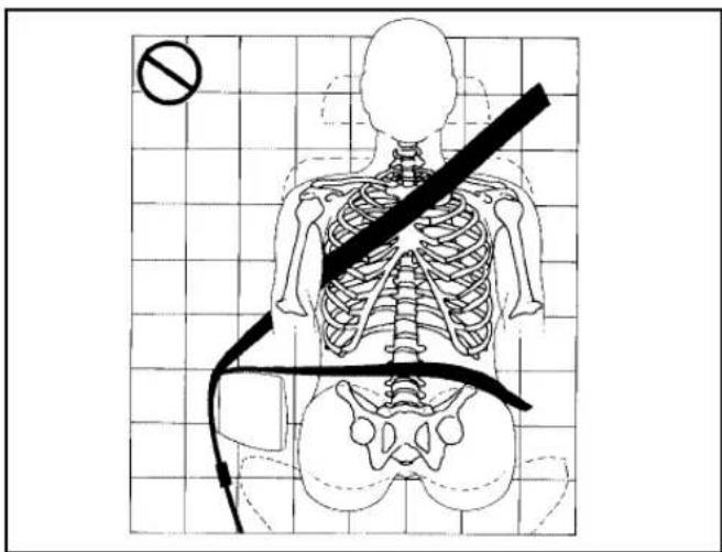 Medical diagram showing human skeleton with a diagonal band and a no-smoking symbol, overlaid on a grid background.