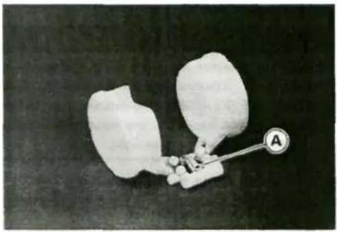 Medical implant device with labeled point A, showing two large white components mounted on a central rod (no text or symbols beyond label)