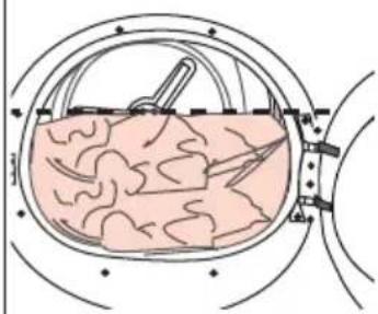 Diagram of a biological or medical procedure inside a circular chamber, showing internal tissue and a tool inserted (no text or labels)