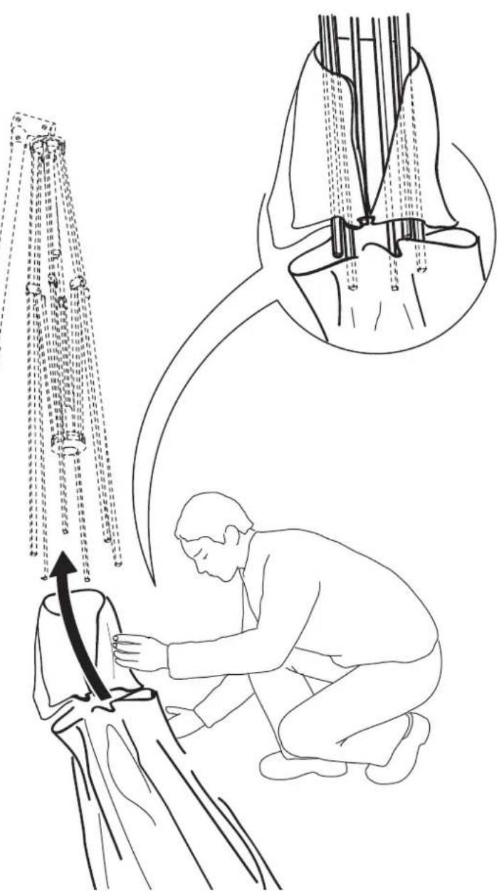 Medical illustration showing a procedure on catheter insertion, with labeled anatomical structures and an inset diagram of the catheter placement.