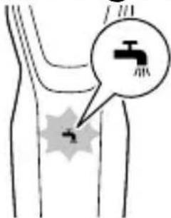 Medical diagram showing a surgical procedure on human leg with labeled components and a magnified view of the catheter.