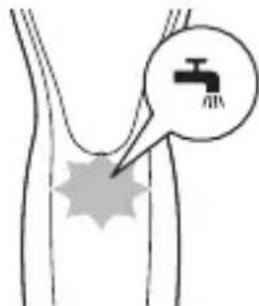 Medical diagram showing a surgical procedure with a labeled component 'AIA' and a droplet symbol.
