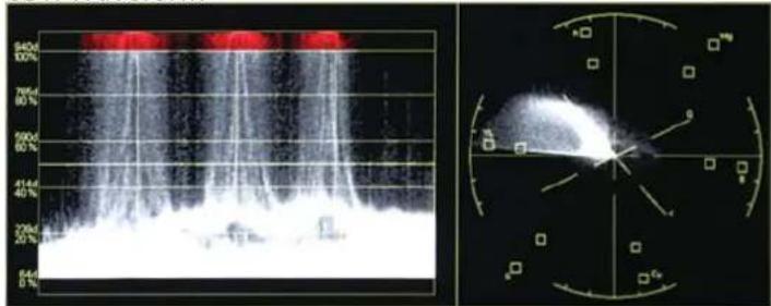 Medical ultrasound image and radiographic scan of a heart with red vascular structures, showing grayscale Doppler flow and measurement scale.