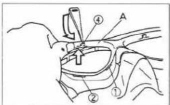 Medical diagram showing anatomical or procedural steps with labeled parts ①, ②, and ④, likely from a medical or surgical procedure.