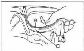Medical diagram showing anatomical or pathological structures with labeled parts B and C