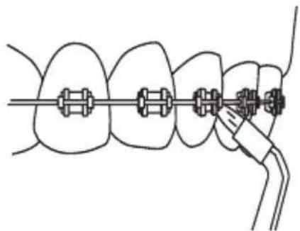 Waterpik WP-110 - Orthodontic Tip - 1