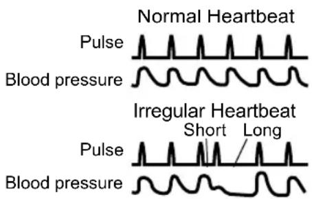 OMRON M6W Wide Cuff - What is Irregular Heartbeat? - 1
