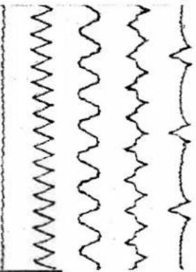 PFAFF 339 - Automatic Fashion Stitching - 4