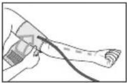 Illustration of a person's leg with a medical device attached, showing no text or symbols