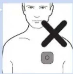 Medical diagram showing a human torso with a cross mark and a medical device symbol, likely indicating a medical or diagnostic marker.