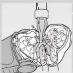 Medical illustration showing a surgical procedure on internal organs (no text or labels)