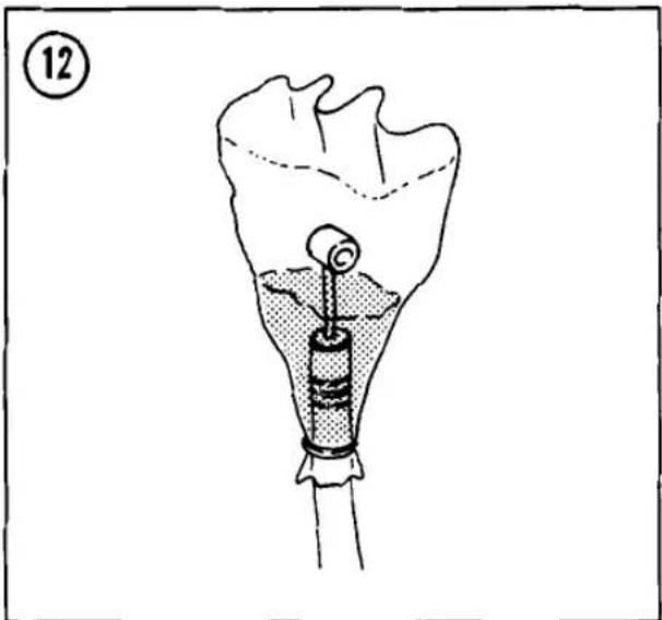Diagram of a medical implant or implant device inserted into a body cavity, showing internal structure and no text or symbols.