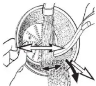 Medical illustration showing surgical procedure with arrows indicating movement (no text or labels)