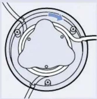 Diagram of a medical or surgical procedure showing a circular component with internal structures and a blue arrow indicating direction (no text or symbols present)