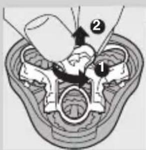 Medical diagram showing anatomical structures with numbered labels 1 and 2, likely illustrating a surgical or procedural procedure.