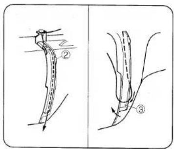 Diagram illustrating two stages of a medical procedure involving a catheter or tube, labeled with numbers ② and ③.